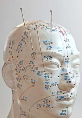 מטפל בדיקור סיני בראשון ציון